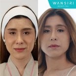 Before and after facelift results at Wansiri Hospital, visible facial rejuvenation outcome