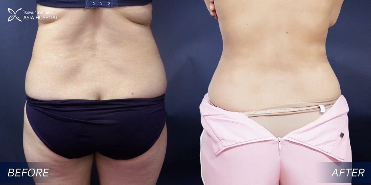 Vorher-nachher-Liposuktionsergebnis bei Asia Cosmetic Hospital, sichtbare Taillenverbesserung