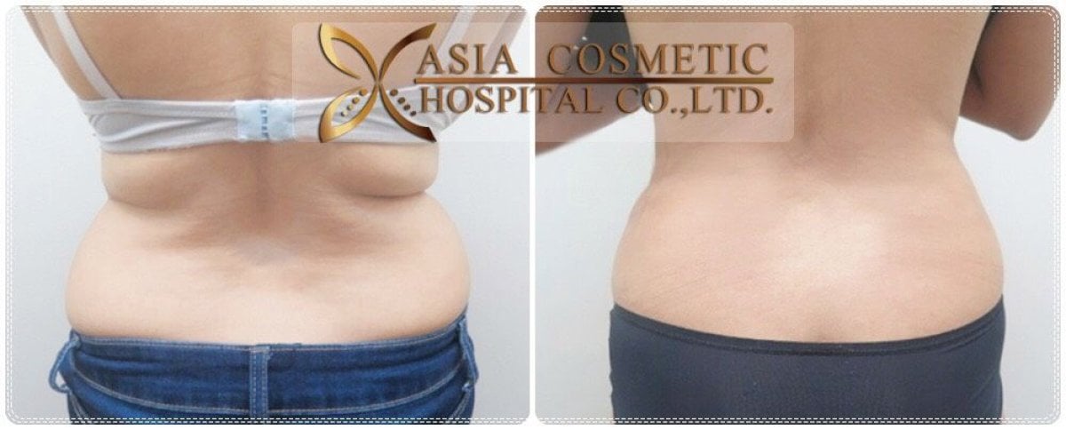Vorher-nachher-Liposuktionsergebnis bei Asia Cosmetic Hospital, sichtbare Taillenverbesserung