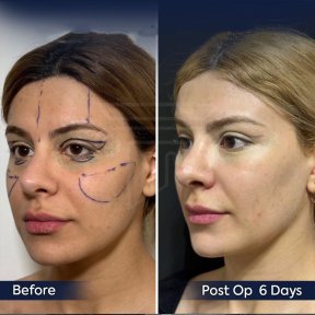 Brow Lift Vorher-Nachher-Ergebnis bei Dr. Safa Manav Clinic, sichtbare Stirn- und Augenanhebung