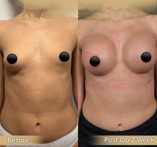 Vorher-nachher-Ergebnis Bruststraffung bei Dr. Safa Manav Clinic, sichtbare Konturverbesserung