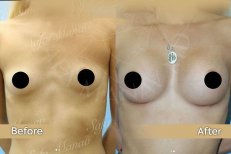 Vorher-nachher-Ergebnis Bruststraffung bei Dr. Safa Manav Clinic, sichtbare Konturverbesserung