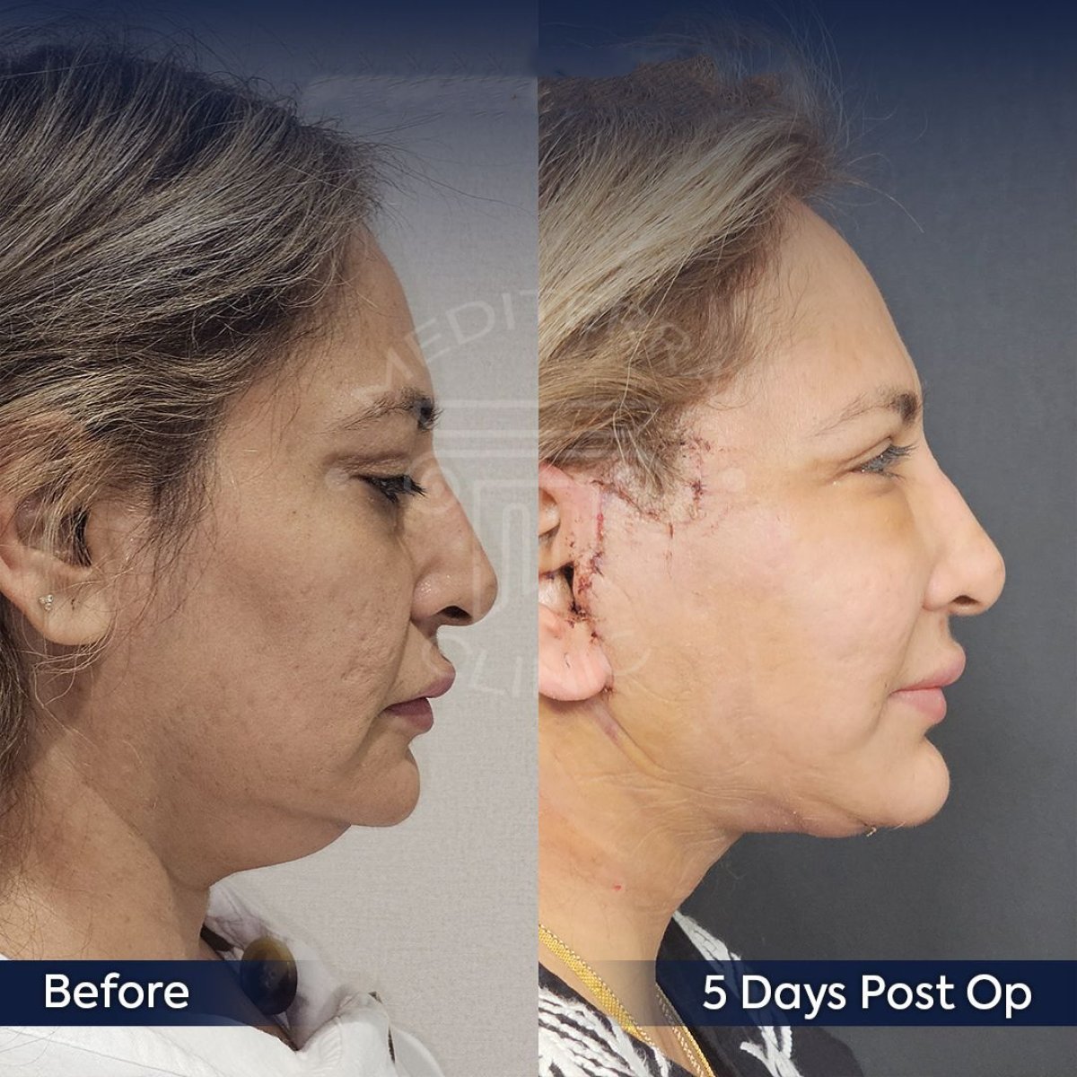 Resultados de liposucción de mentón antes y después en Dr. Safa Manav Clinic, contorno mejorado