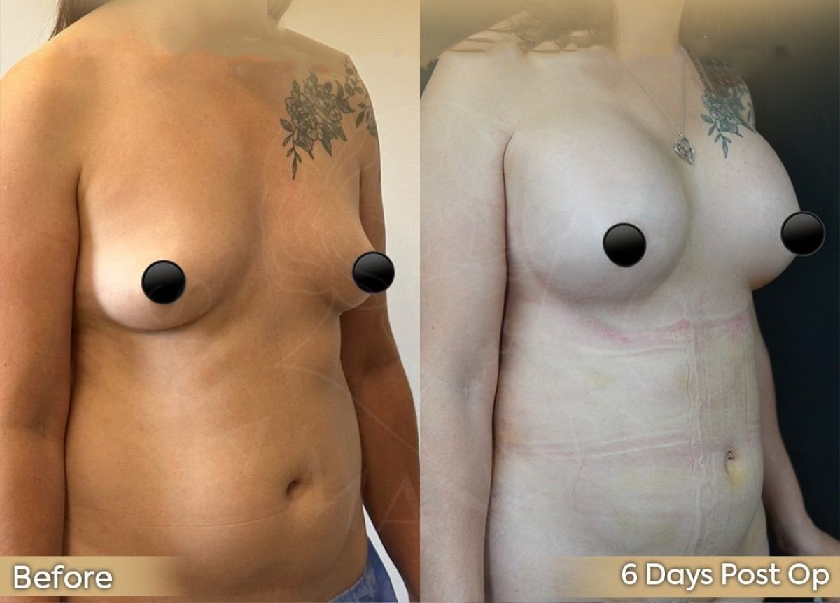Vorher-nachher-Ergebnis Bruststraffung bei Dr. Safa Manav Clinic, sichtbare Straffung
