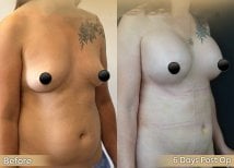 Before and after breast lift results at Dr. Safa Manav Clinic, visible lift and contour