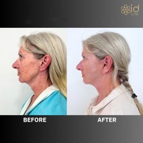 Before and after neck lift results at ID Clinic Bangkok, visible neck contour improvement