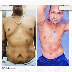 Before and after tummy tuck results at CE International Hospital, improved abdominal contour