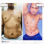 Before and after tummy tuck results at CE International Hospital, improved abdominal contour
