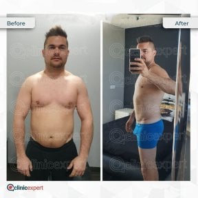 Before and after tummy tuck results at CE International Hospital, visible abdominal contouring