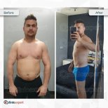 Before and after tummy tuck results at CE International Hospital, visible abdominal contouring