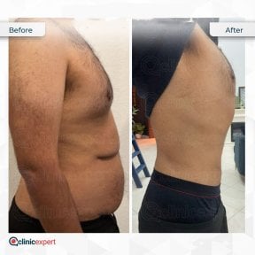 Tummy tuck before and after results at CE International Hospital, visible flatter abdomen