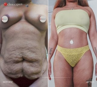 Résultats avant/après abdominoplastie et liposuccion à CE International Hospital, ventre plat