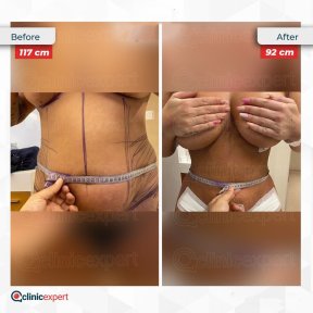 Vorher-nachher-Ergebnisse von Bauchdeckenstraffung und Fettabsaugung bei CE International Hospital, Taillenreduktion