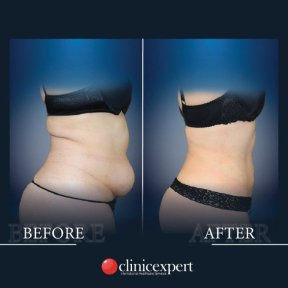 Before and after tummy tuck and liposuction results at CE International Hospital, flatter abdomen