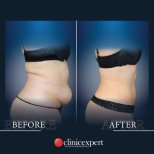 Before and after tummy tuck and liposuction results at CE International Hospital, flatter abdomen
