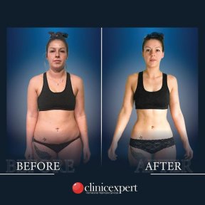 Before and after tummy tuck and liposuction results at CE International Hospital
