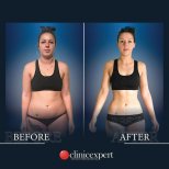 Before and after tummy tuck and liposuction results at CE International Hospital