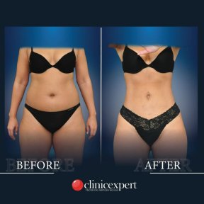 Vorher-nachher-Ergebnisse Bauchdeckenstraffung und Fettabsaugung bei CE International Hospital, Körperkontur