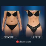 Vorher-nachher-Ergebnisse Bauchdeckenstraffung und Fettabsaugung bei CE International Hospital, Körperkontur