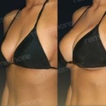 Before and after breast augmentation with fat transfer at Memorial Bahçelievler Hospital results