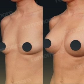 Before and after breast augmentation with fat transfer at Memorial Bahçelievler Hospital result