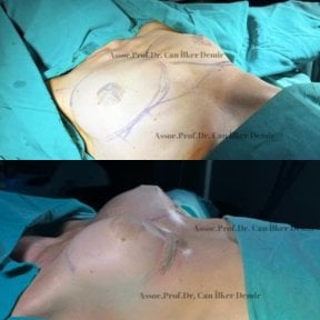 Before and after breast augmentation with fat transfer at Memorial Bahçelievler Hospital result