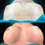 Before and after breast augmentation with fat transfer at Memorial Bahçelievler Hospital results