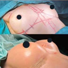 Before and after breast augmentation with fat transfer at Memorial Bahçelievler Hospital results