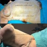 نتائج قبل وبعد عملية تجميل الأم في مستشفى Memorial Bahçelievler، تنسيق القوام