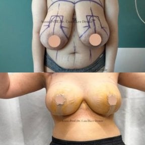 До та після мамопластики в Memorial Bahçelievler Hospital, результат підтяжки грудей