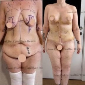 Resultados antes y después de mommy makeover en Memorial Bahçelievler Hospital, contorno corporal