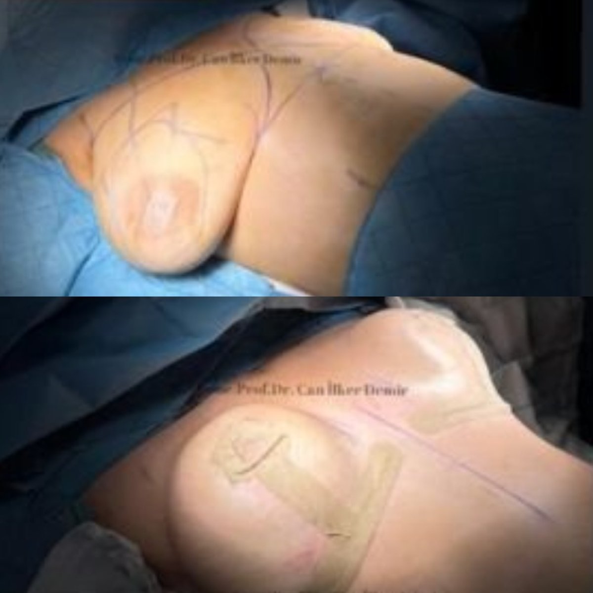 Vorher-nachher-Ergebnis Bruststraffung bei Mommy Makeover im Memorial Bahçelievler Hospital