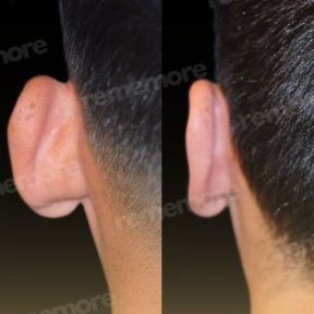 Before and after otoplasty results at Memorial Ataşehir Hospital, ear reshaping surgery