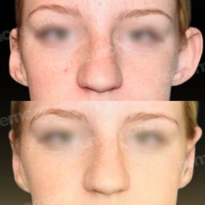 Before and after otoplasty results at Memorial Ataşehir Hospital, ear reshaping surgery