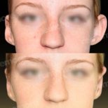 Before and after otoplasty results at Memorial Ataşehir Hospital, ear reshaping surgery