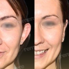 Before and after otoplasty results at Memorial Ataşehir Hospital, ear reshaping surgery