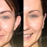 Before and after otoplasty results at Memorial Ataşehir Hospital, ear reshaping surgery