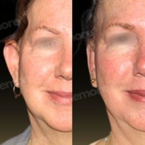 Before and after otoplasty results at Memorial Ataşehir Hospital, improved ear shape