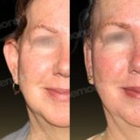 Before and after otoplasty results at Memorial Ataşehir Hospital, improved ear shape