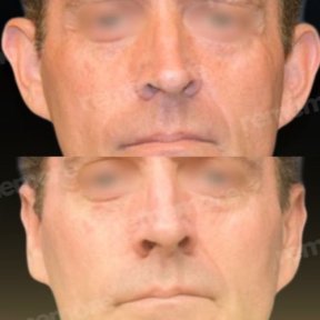 Otoplasty before and after results at Memorial Ataşehir Hospital, ear reshaping surgery
