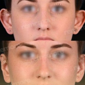 Before and after otoplasty results at Memorial Ataşehir Hospital, ear reshaping surgery