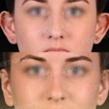 Before and after otoplasty results at Memorial Ataşehir Hospital, ear reshaping surgery
