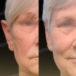 Otoplasty before and after results at Memorial Ataşehir Hospital, improved ear shape in adult