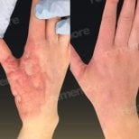 Before and after skin grafting for burns on hand at Memorial Şişli Hospital, visible healing result