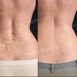 Before and after skin grafting for burns at Memorial Şişli Hospital, visible scar reduction result