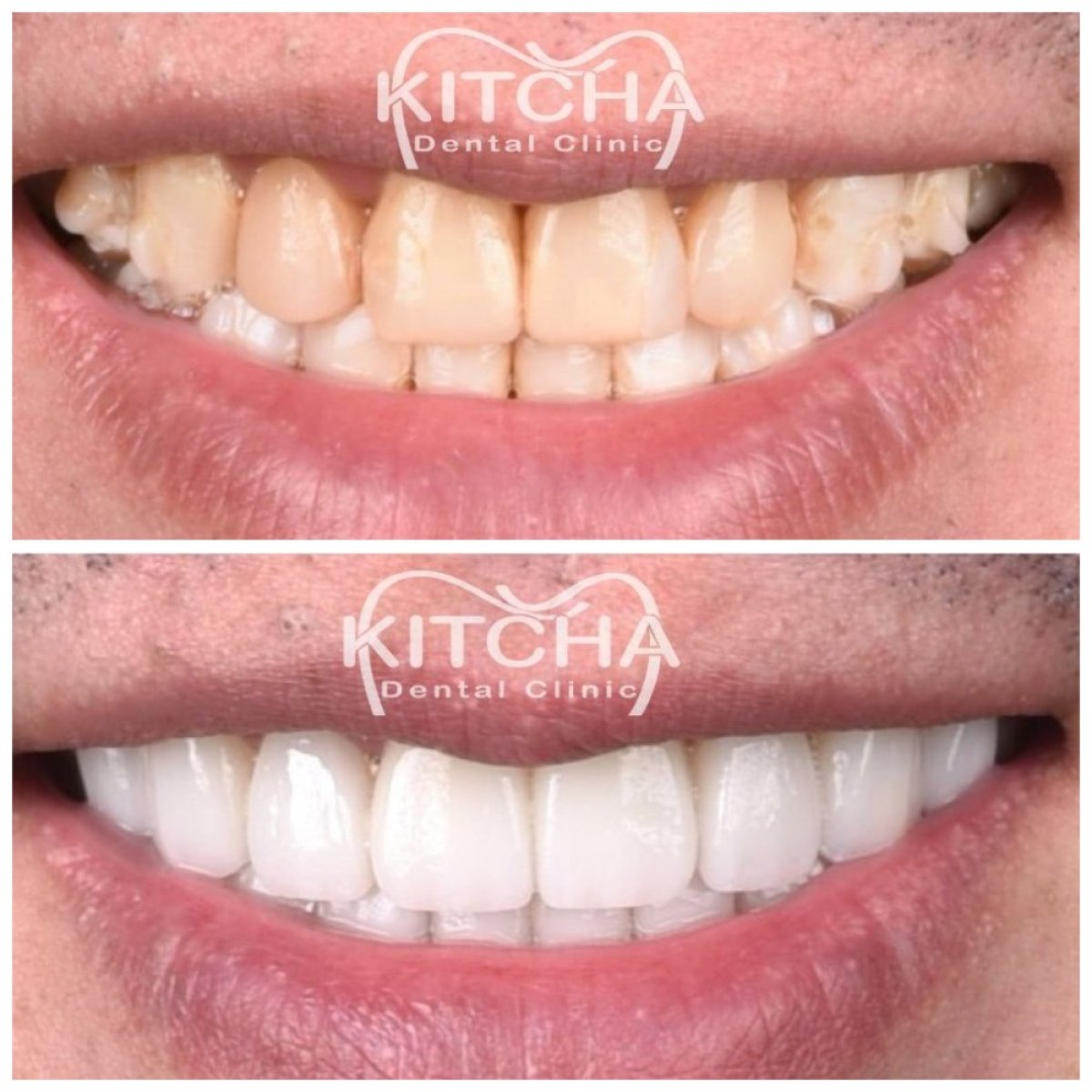 Resultados antes y después de carillas de porcelana en Kitcha Dental Clinic, transformación de sonrisa