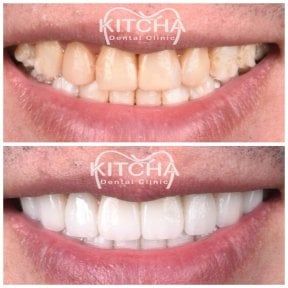Before and after porcelain veneer results at Kitcha Dental Clinic, smile transformation
