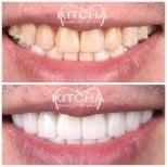 Before and after porcelain veneer results at Kitcha Dental Clinic, smile transformation