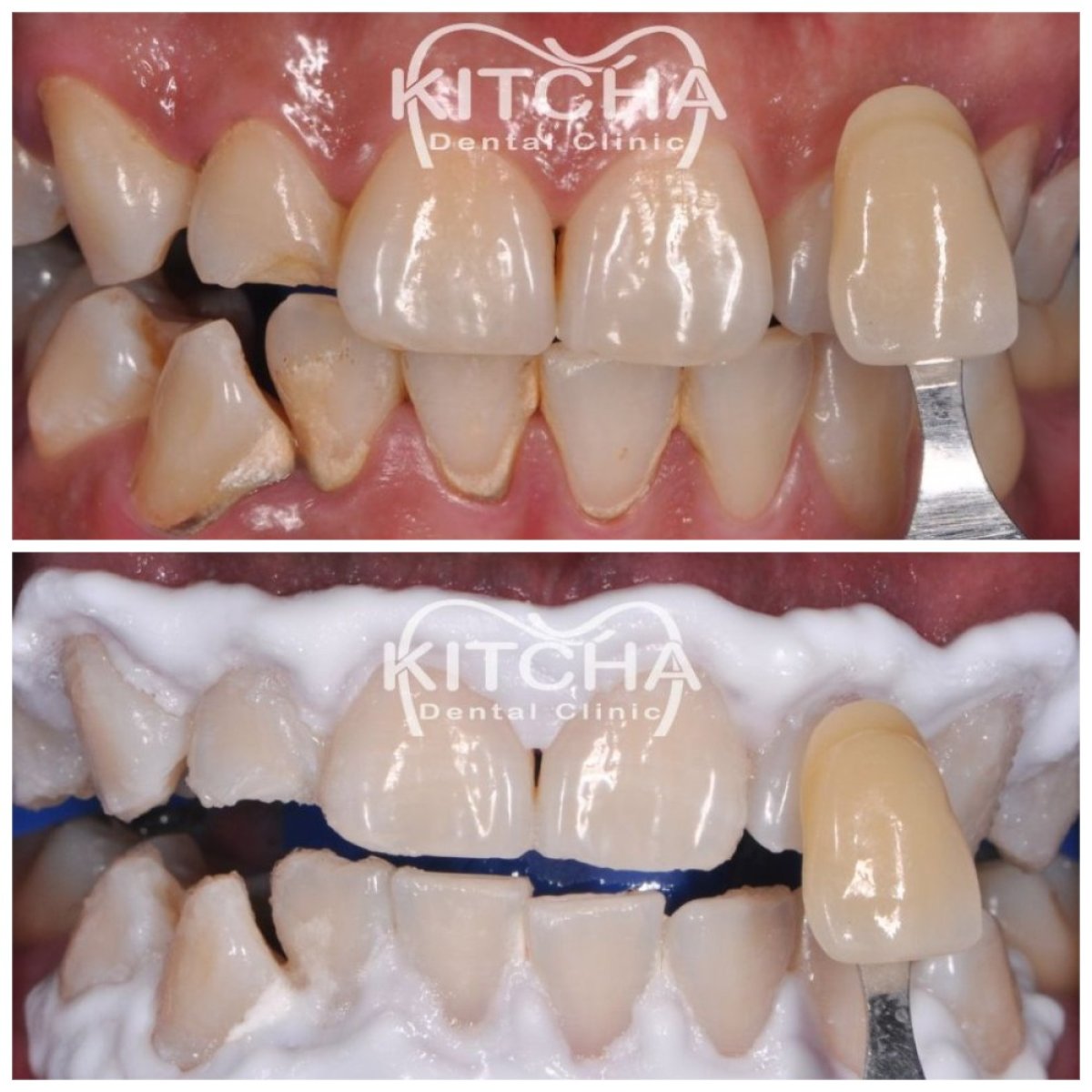 Vorher-nachher-Ergebnis Zahnaufhellung bei Kitcha Dental Clinic, sichtbar weißere Zähne