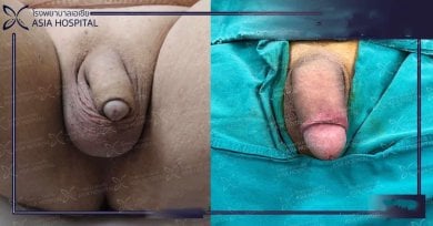 Résultats avant/après d’agrandissement du pénis à Asia Cosmetic Hospital, taille accrue